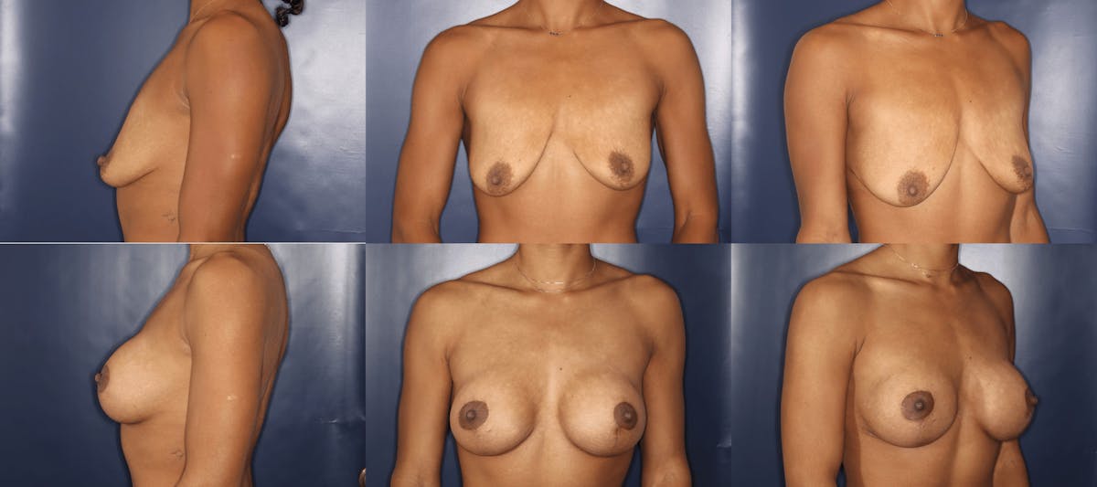 Breast Augmentation Before & After Gallery - Patient 183365 - Image 1