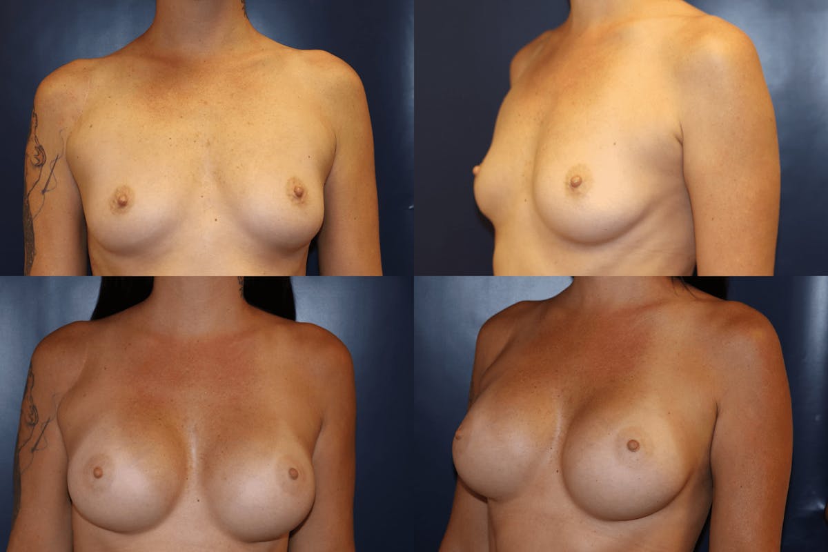 Breast Augmentation Before & After Gallery - Patient 420509 - Image 1