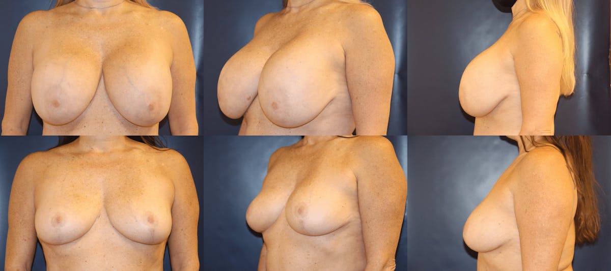 Explantation of Implants Before & After Gallery - Patient 231616 - Image 1