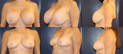 Explantation of Implants Before & After Gallery - Patient 231616 - Image 1