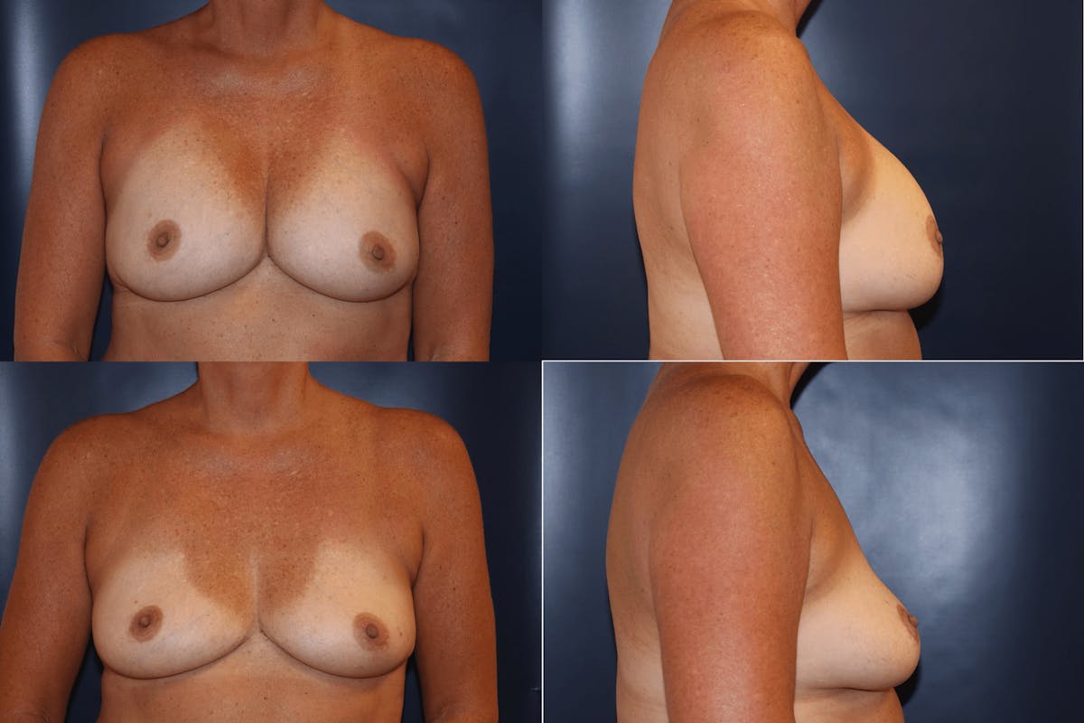 Explantation of Implants Before & After Gallery - Patient 390499 - Image 1