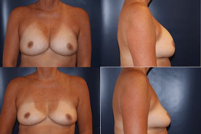 Explantation of Implants Before & After Gallery - Patient 390499 - Image 1
