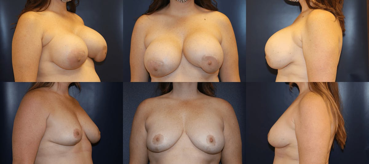 Explantation of Implants Before & After Gallery - Patient 287326 - Image 1