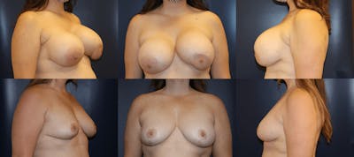Explantation of Implants Before & After Gallery - Patient 287326 - Image 1