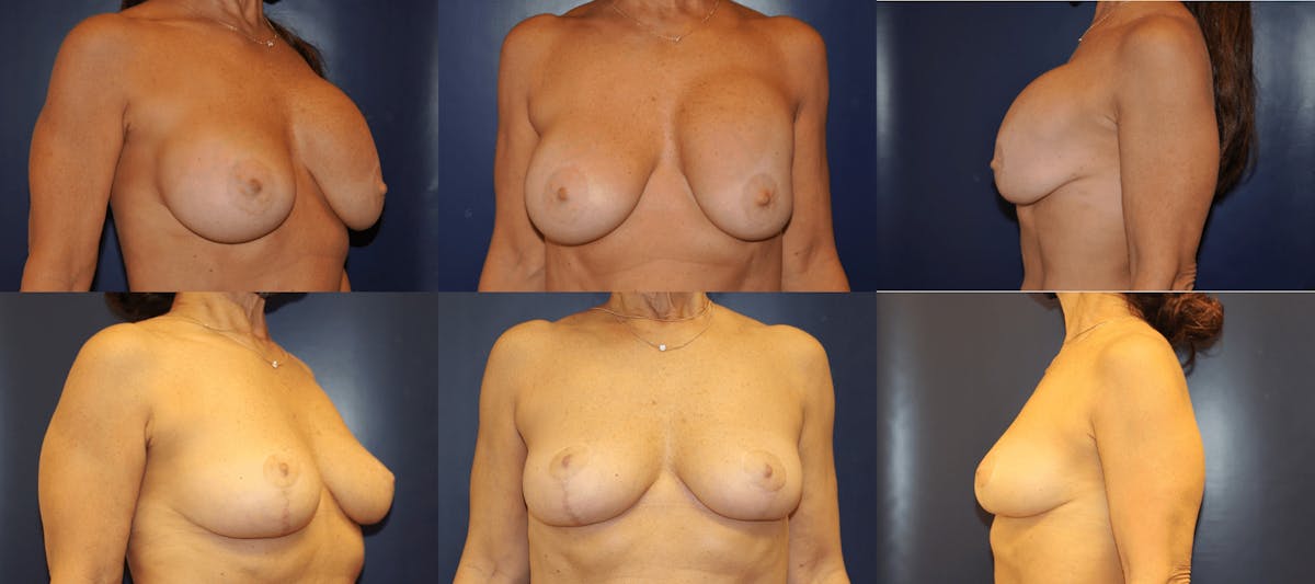 Explantation of Implants Before & After Gallery - Patient 129310 - Image 1