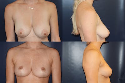 Breast Reduction Before & After Gallery - Patient 405991 - Image 1