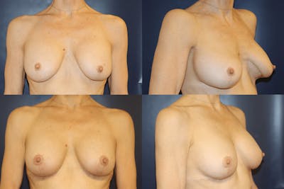 Breast Reconstruction / Revision / Implant Exchange Before & After Gallery - Patient 101542 - Image 1