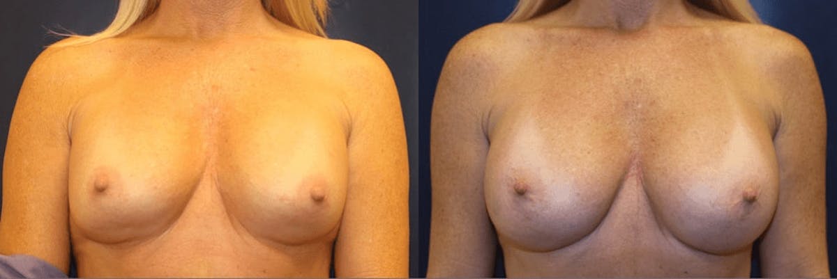 Breast Reconstruction / Revision / Implant Exchange Before & After Gallery - Patient 101946 - Image 1
