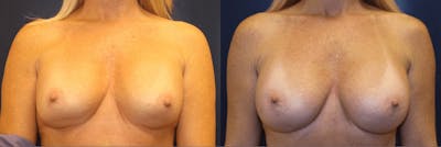 Breast Reconstruction / Revision / Implant Exchange Before & After Gallery - Patient 101946 - Image 1
