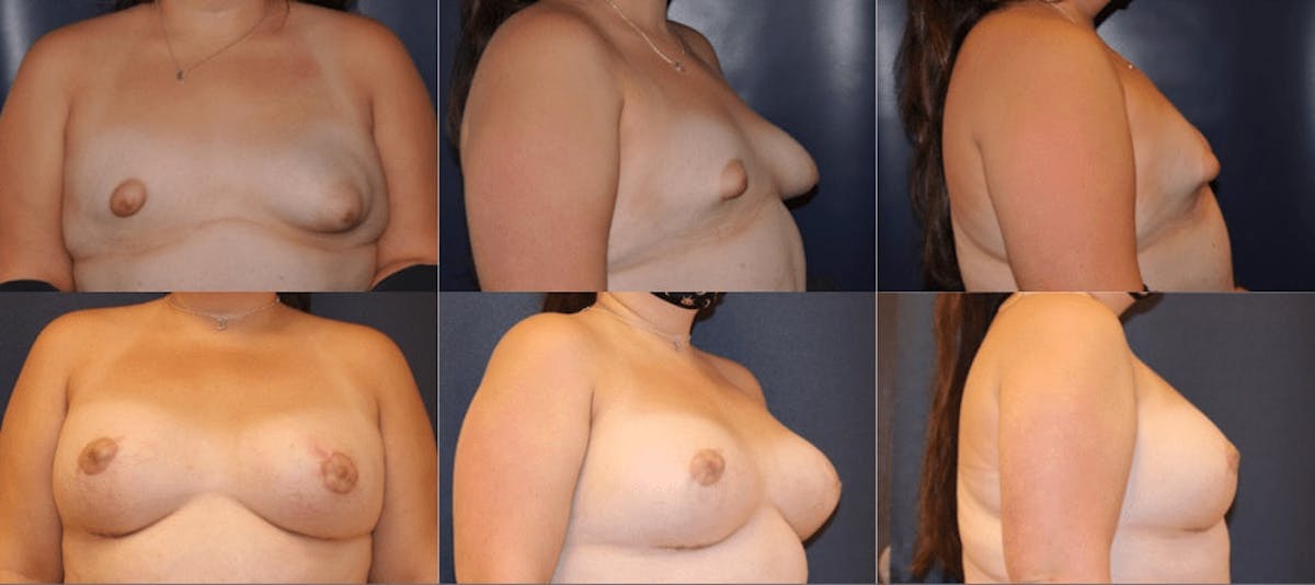 Breast Augmentation Before & After Gallery - Patient 891390 - Image 1