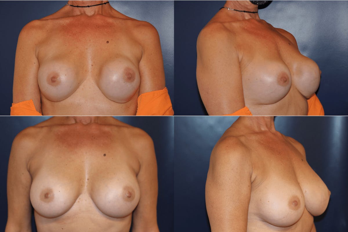 Breast Reconstruction / Revision / Implant Exchange Before & After Gallery - Patient 206929 - Image 1