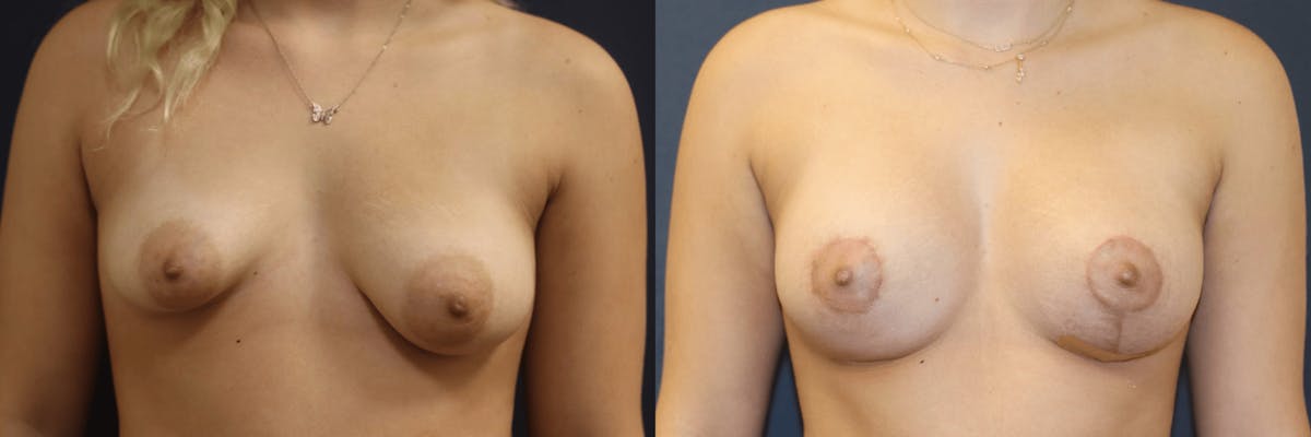 Breast Reconstruction / Revision / Implant Exchange Before & After Gallery - Patient 322377 - Image 1