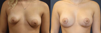 Breast Reconstruction / Revision / Implant Exchange Before & After Gallery - Patient 322377 - Image 1