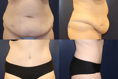 Abdominoplasty Before & After Gallery - Patient 150661 - Image 1