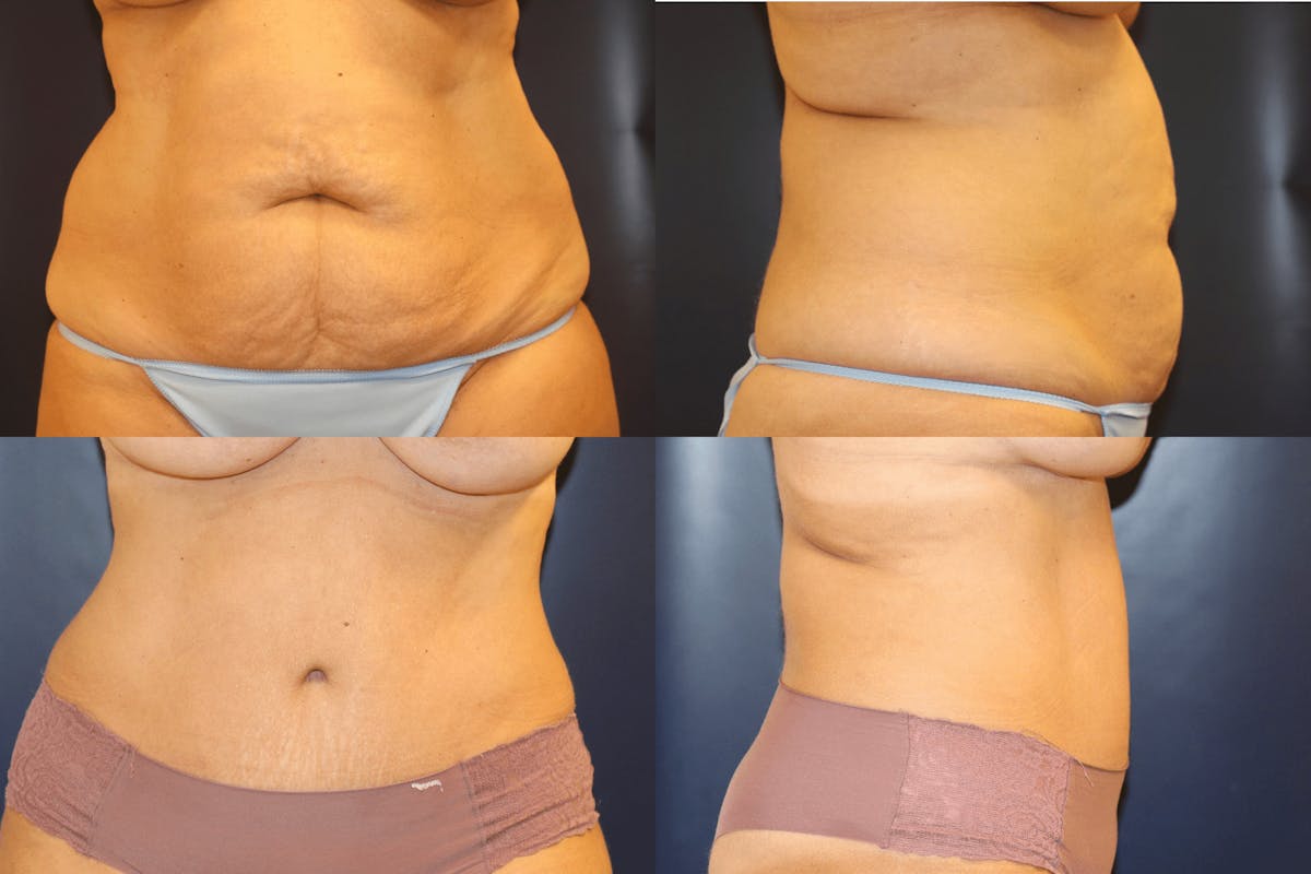 Abdominoplasty Before & After Gallery - Patient 311751 - Image 1