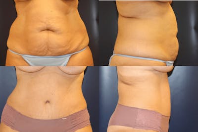 Abdominoplasty Before & After Gallery - Patient 311751 - Image 1