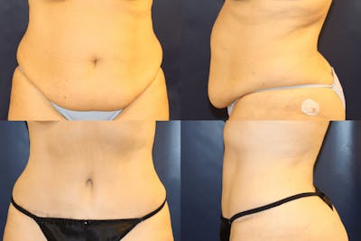 Abdominoplasty Before & After Gallery - Patient 250199 - Image 1