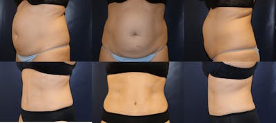 Abdominoplasty Before & After Gallery - Patient 196358 - Image 1