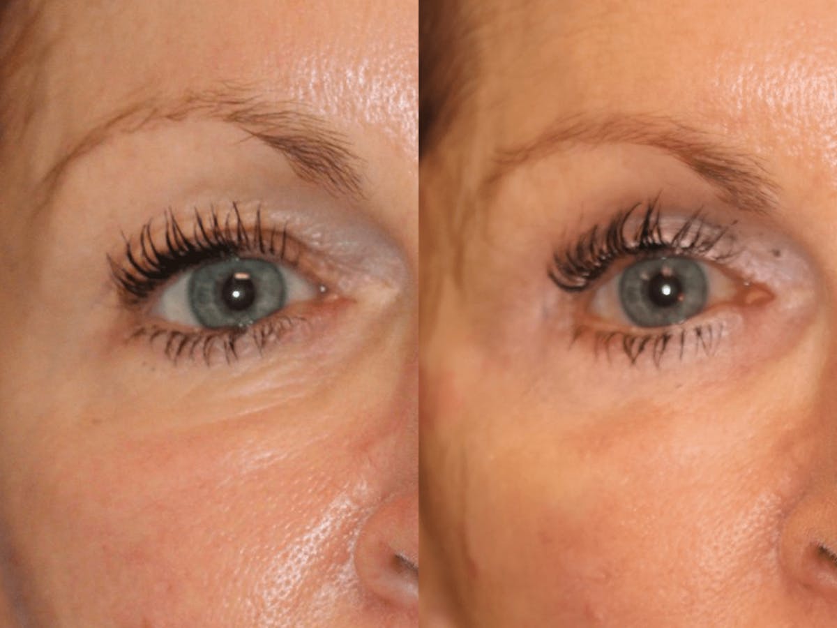 In office Upper Lid Blepharoplasty Before & After Gallery - Patient 857769 - Image 1