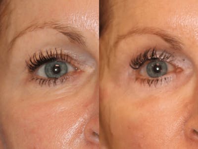 In office Upper Lid Blepharoplasty Before & After Gallery - Patient 857769 - Image 1