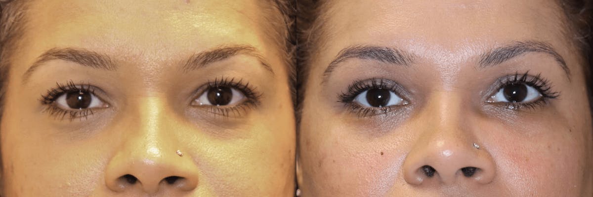 In office Upper Lid Blepharoplasty Before & After Gallery - Patient 175991 - Image 1