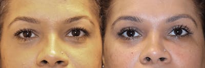 In office Upper Lid Blepharoplasty Before & After Gallery - Patient 175991 - Image 1