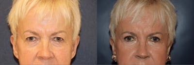 In office Upper Lid Blepharoplasty Before & After Gallery - Patient 239216 - Image 1