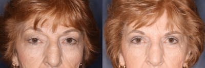 In office Upper Lid Blepharoplasty Before & After Gallery - Patient 461083 - Image 1