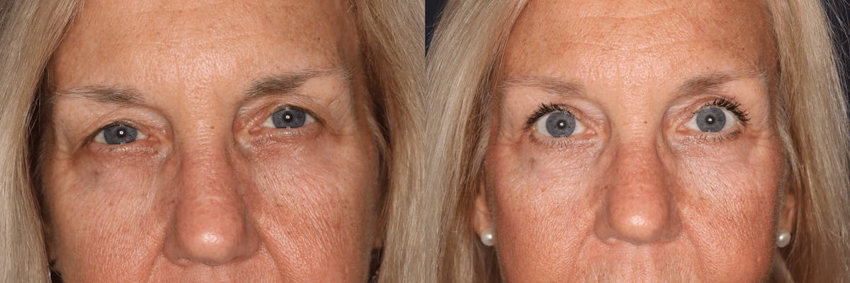 In office Upper Lid Blepharoplasty Before & After Gallery - Patient 300997 - Image 1