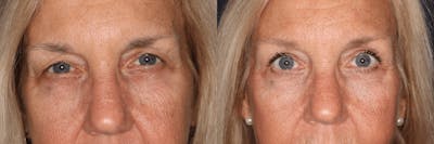In office Upper Lid Blepharoplasty Before & After Gallery - Patient 300997 - Image 1