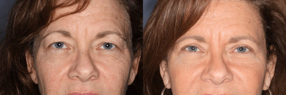 In office Upper Lid Blepharoplasty Before & After Gallery - Patient 231011 - Image 1