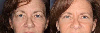In office Upper Lid Blepharoplasty Before & After Gallery - Patient 231011 - Image 1