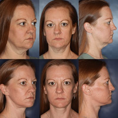 Facelift Before & After Gallery - Patient 322544 - Image 1