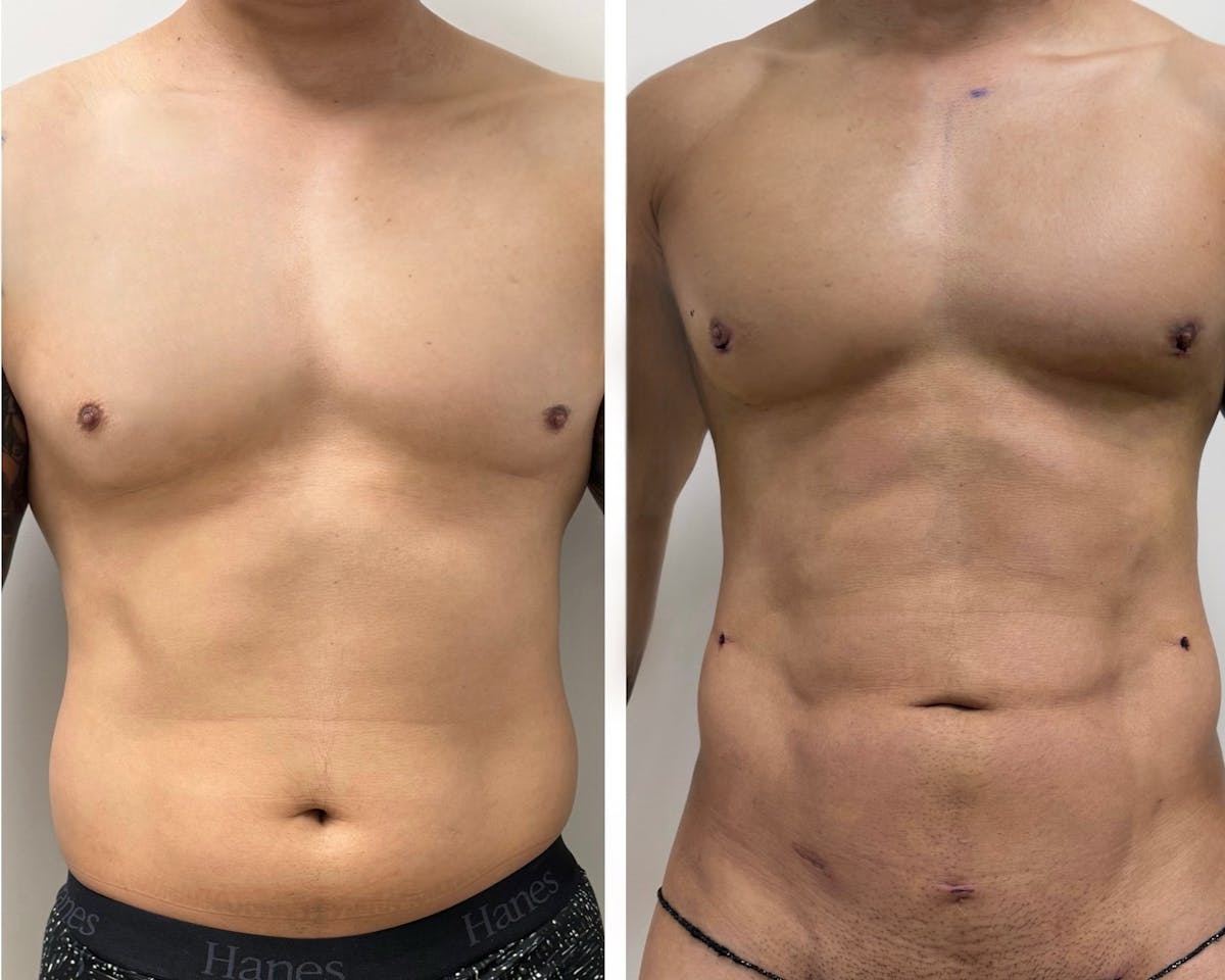 Abdominal Etching Before & After Gallery - Patient 158222 - Image 1