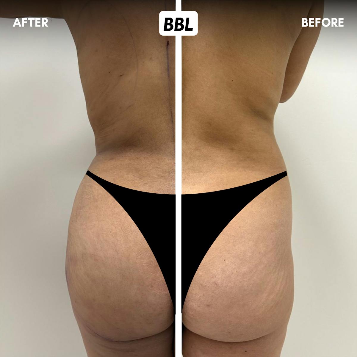 Brazilian Butt Lift Before & After Gallery - Patient 411554 - Image 1