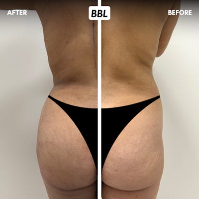 Brazilian Butt Lift Before & After Gallery - Patient 411554 - Image 1
