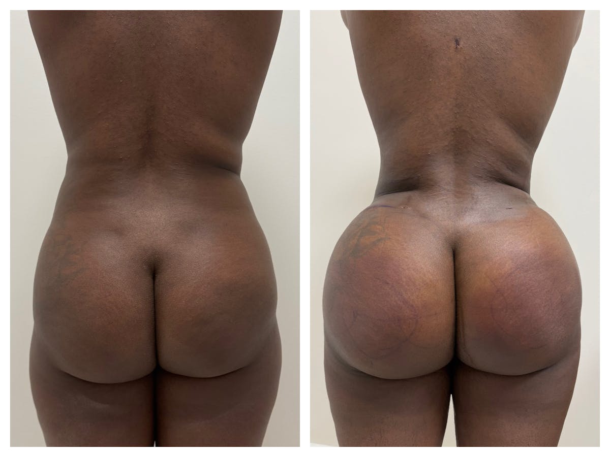 Brazilian Butt Lift Before & After Gallery - Patient 401923 - Image 1