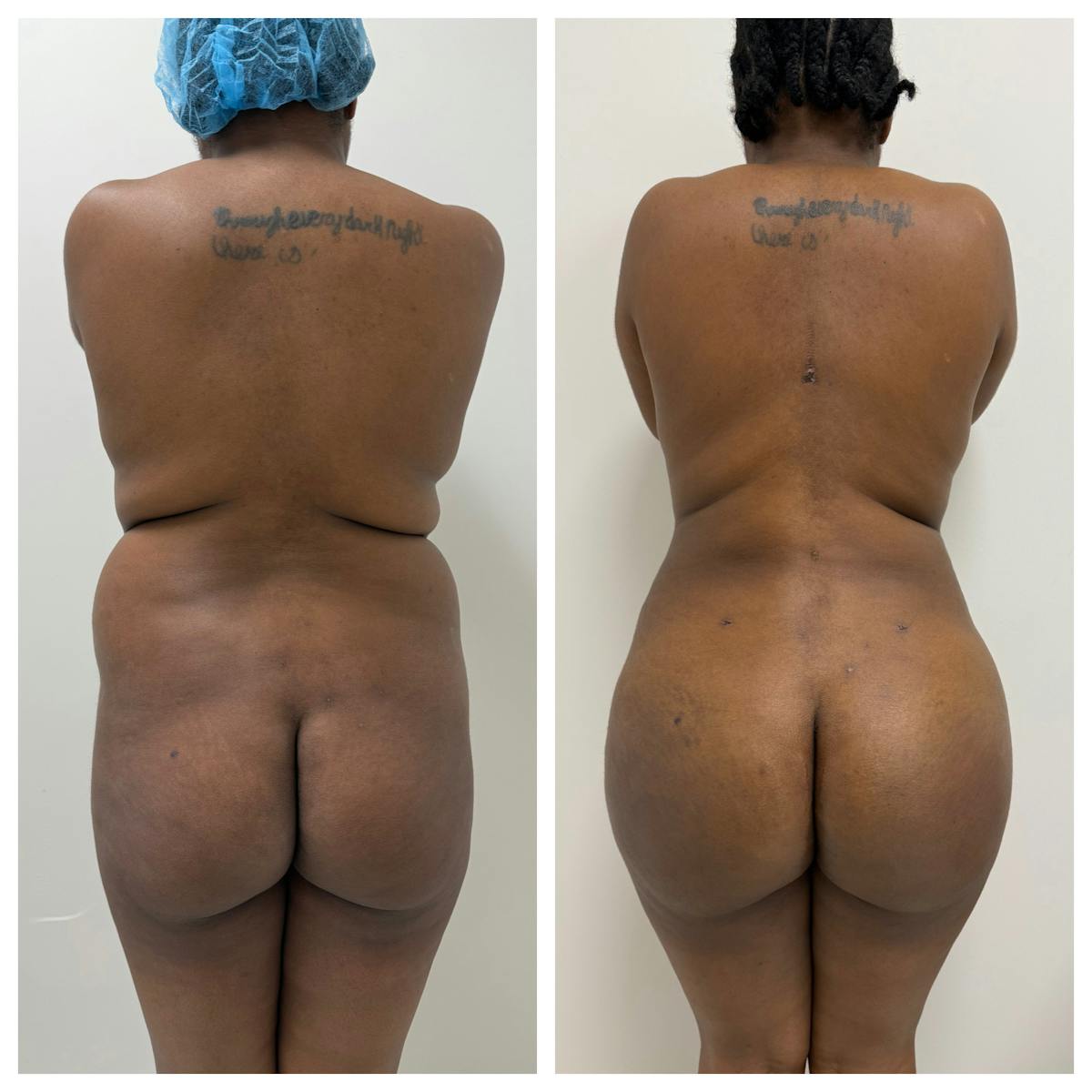 Brazilian Butt Lift Before & After Gallery - Patient 250250 - Image 1