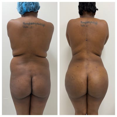 Brazilian Butt Lift Before & After Gallery - Patient 250250 - Image 1