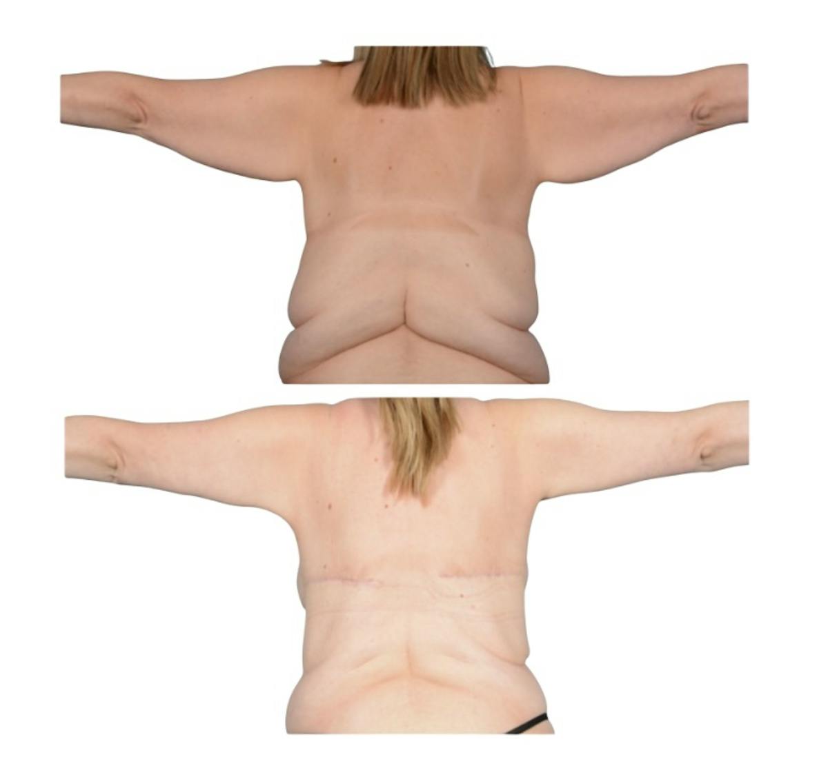 Brachioplasty Before & After Gallery - Patient 134295 - Image 1