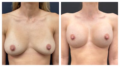 Breast Augmentation Before & After Gallery - Patient 783193 - Image 1