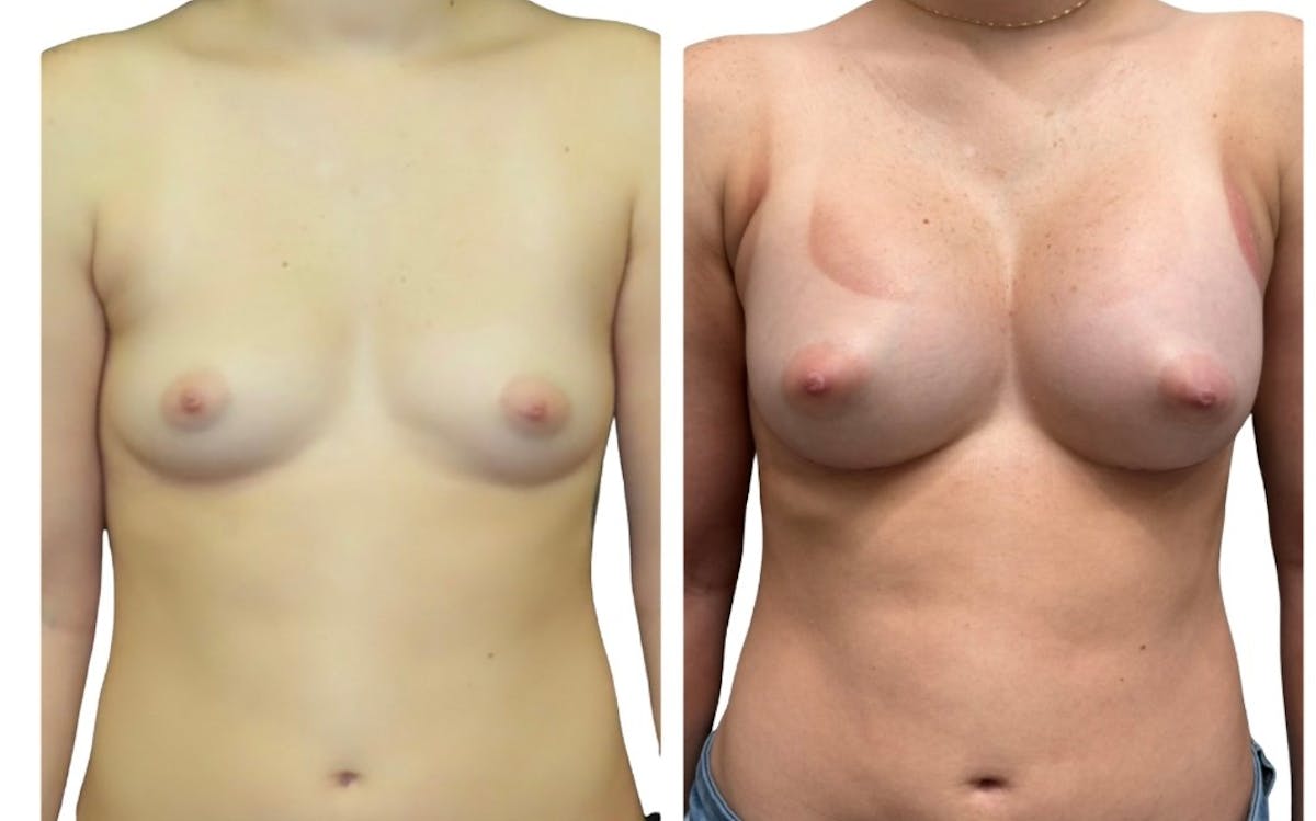 Breast Augmentation Before & After Gallery - Patient 405157 - Image 1
