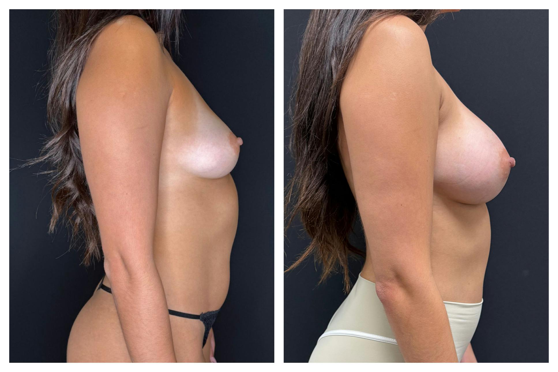 Breast Augmentation Before & After Gallery - Patient 188932 - Image 4