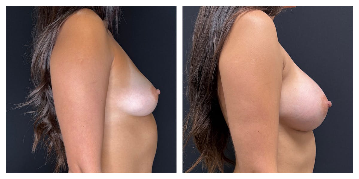 Breast Augmentation Before & After Gallery - Patient 188932 - Image 6