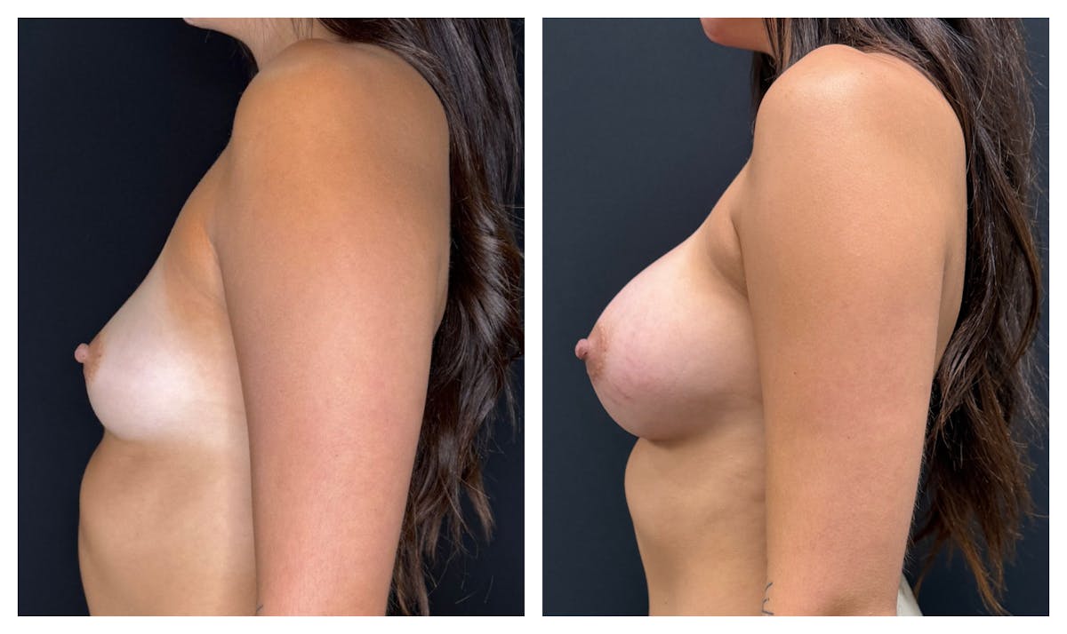 Breast Augmentation Before & After Gallery - Patient 188932 - Image 5