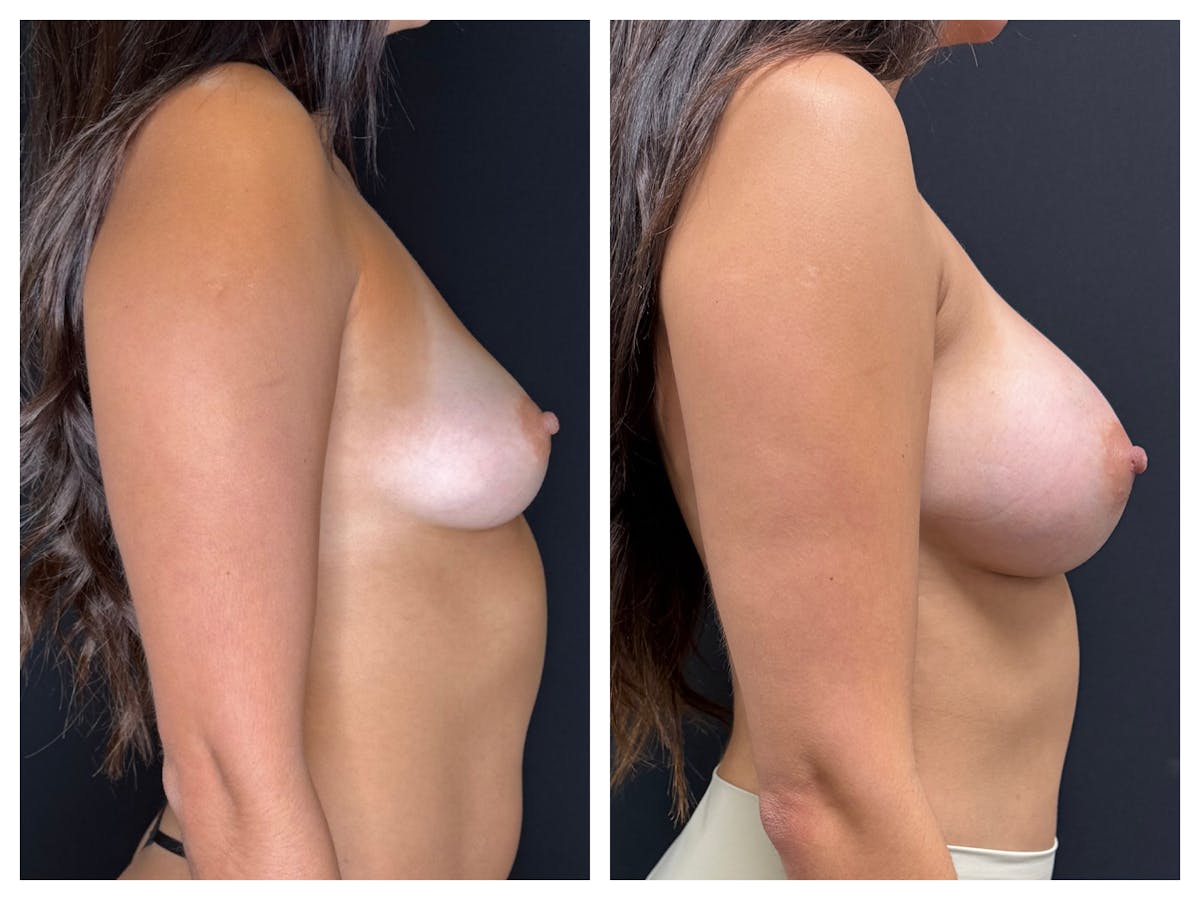 Breast Augmentation Before & After Gallery - Patient 188932 - Image 3