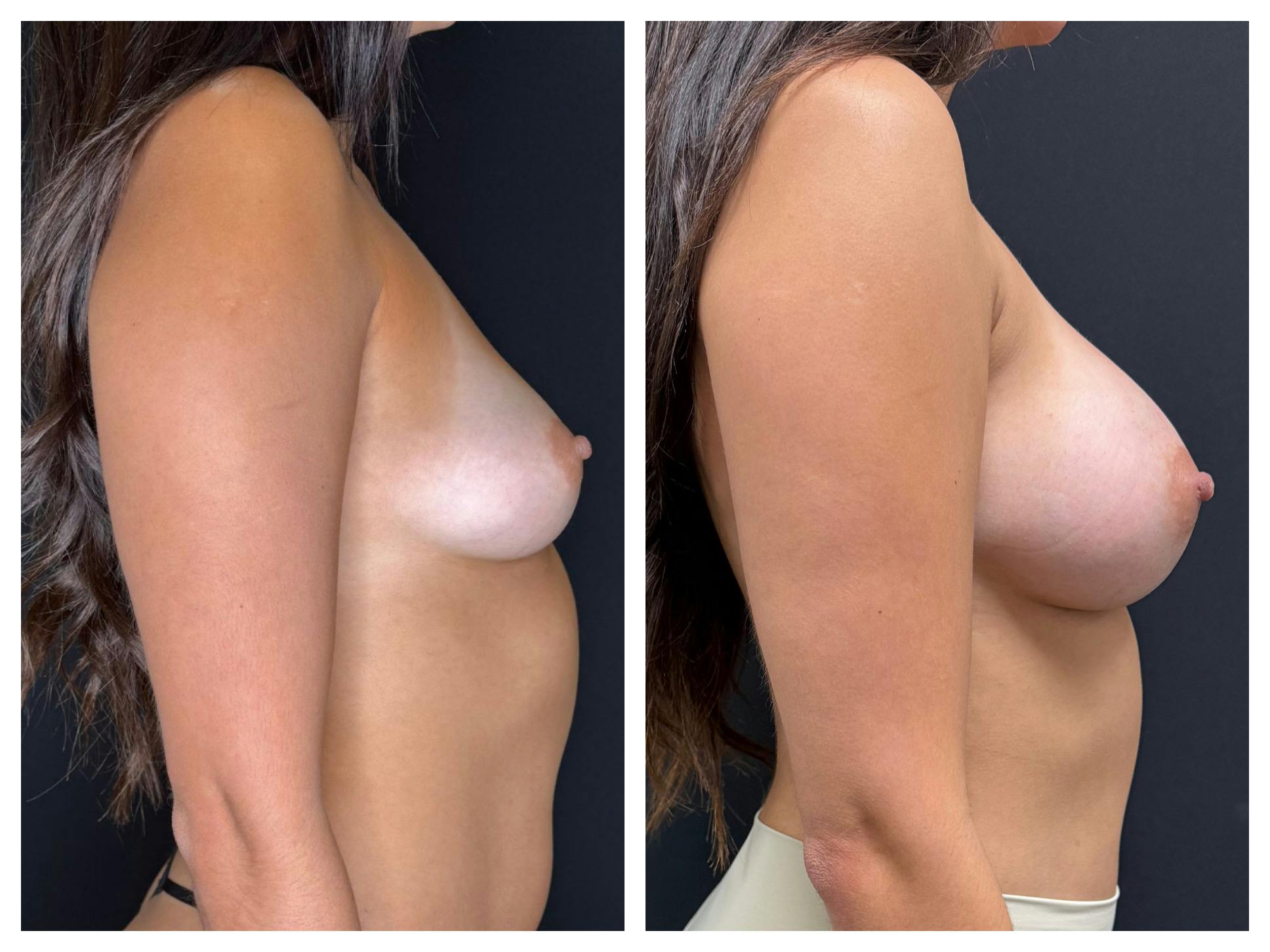 Breast Augmentation Before & After Gallery - Patient 188932 - Image 3