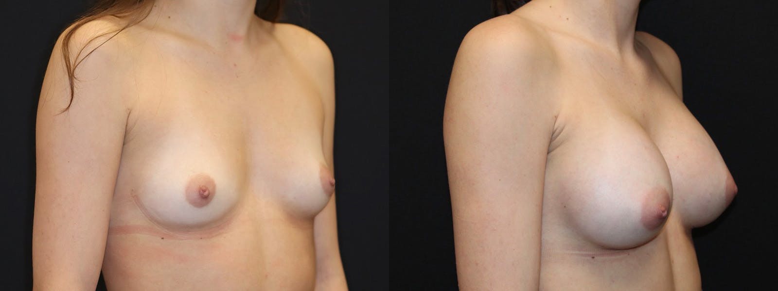 Breast Augmentation Before & After Gallery - Patient 541532 - Image 2