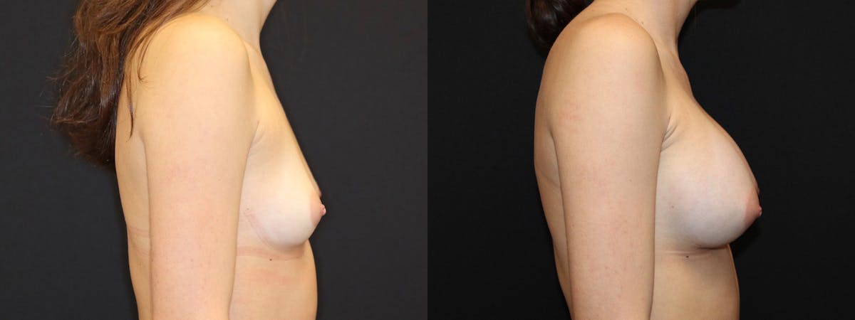 Breast Augmentation Before & After Gallery - Patient 541532 - Image 3