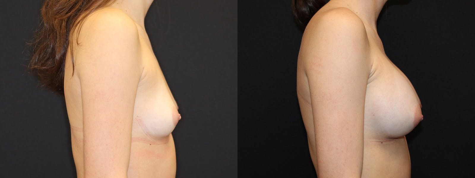 Breast Augmentation Before & After Gallery - Patient 541532 - Image 3